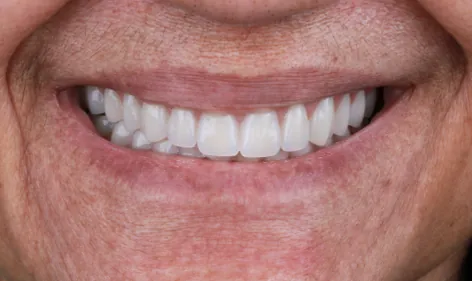 Depois - Prótese Protocolo